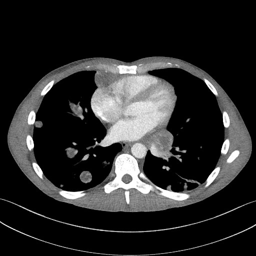 Cannonball metastases - testicular choriocarcinoma (Radiopaedia 84510-99891 B 70).jpg