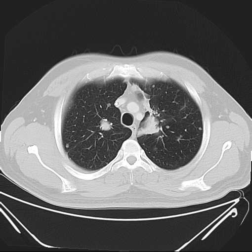 File:Cannonball pulmonary metastases (Radiopaedia 67684-77101 Axial lung window 6).jpg