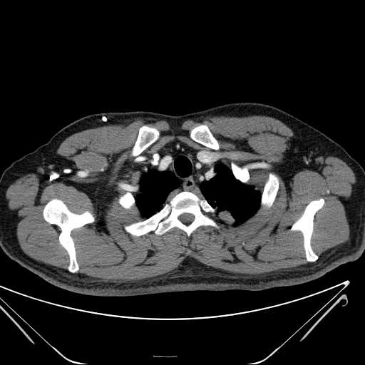 File:Cannonball pulmonary metastases (Radiopaedia 67684-77101 D 30).jpg