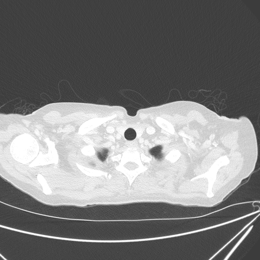 Canonball lung metastasis (Radiopaedia 77634-89837 Axial lung window 14).jpg