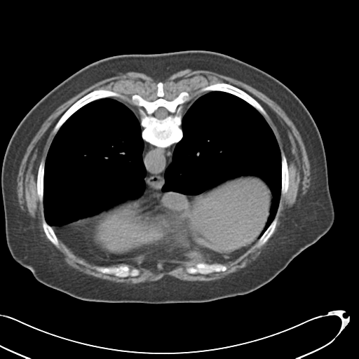 File:Carcinoid tumor - lung (Radiopaedia 44814-48644 Axial non-contrast 15).png