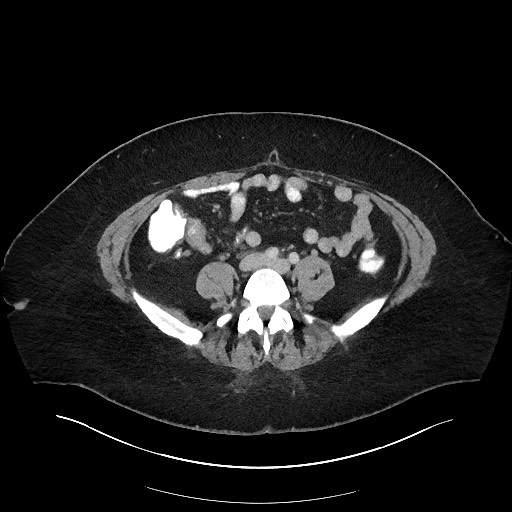 File:Carcinoid tumor - terminal ileum (Radiopaedia 60931-68739 Axial 32).jpg