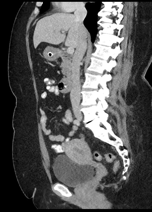 Carcinoid tumor - terminal ileum (Radiopaedia 60931-68739 C 53).jpg
