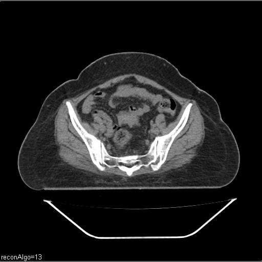 File:Carcinoma cervix- brachytherapy applicator (Radiopaedia 33135-34173 Axial non-contrast 15).jpg