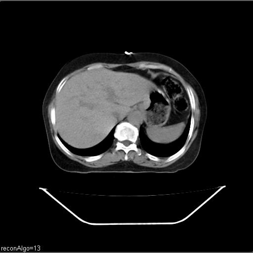 File:Carcinoma cervix- recurrence (Radiopaedia 34702-36137 Axial non-contrast 10).jpg