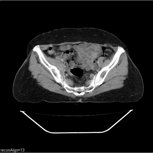 File:Carcinoma cervix- recurrence (Radiopaedia 34702-36137 B 42).jpg