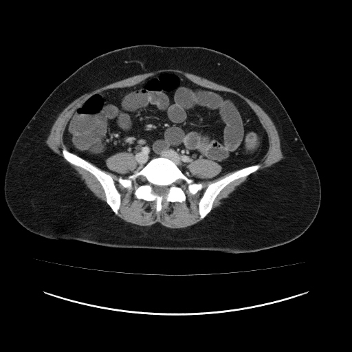 File:Carcinoma colon - hepatic flexure (Radiopaedia 19461-19493 A 86).jpg