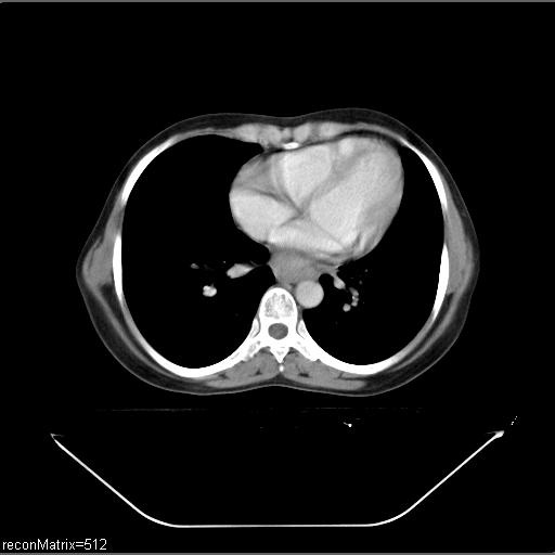 File:Carcinoma of esophagus (Radiopaedia 27356-27550 A 14).jpg
