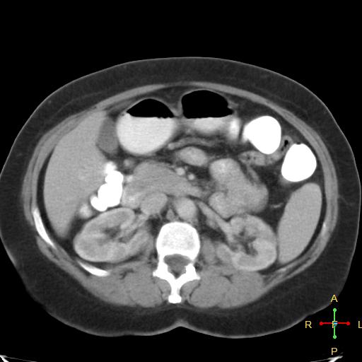 File:Carcinoma of sigmoid colon (Radiopaedia 23071-23100 B 8).jpg