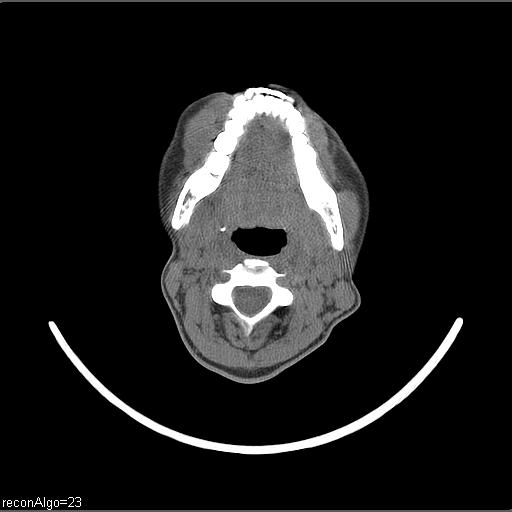 Carcinoma of the maxillary antrum (Radiopaedia 53805-59888 Axial non-contrast 42).jpg