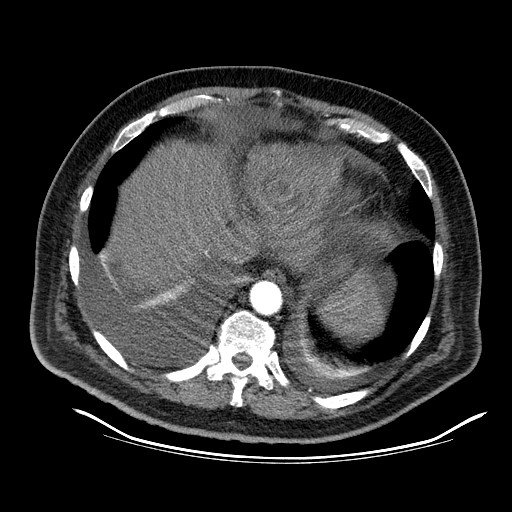 File:Cardiac lymphoma (Radiopaedia 38690-40836 Axial C+ CTPA 18).jpg
