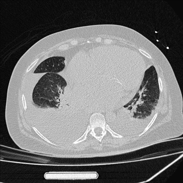 Cardiogenic pulmonary edema (Radiopaedia 29213-29609 Axial lung window 68).jpg