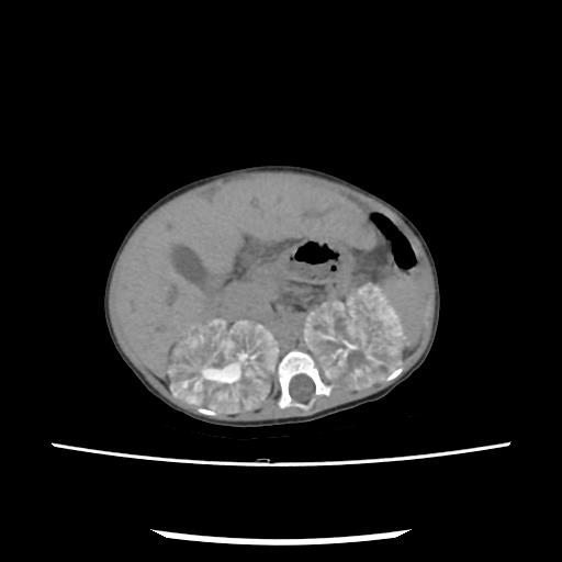 File:Caroli disease with autosomal recessive polycystic kidney disease (ARPKD) (Radiopaedia 89651-106703 E 91).jpg