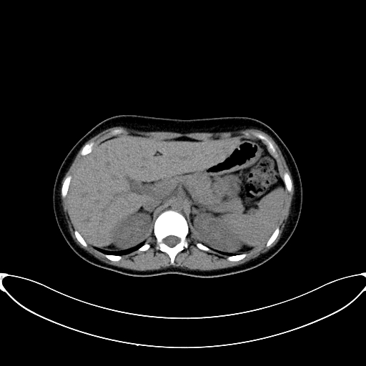 Caroli disease with medullary sponge kidney (Radiopaedia 82622-96804 Axial non-contrast 22).jpg
