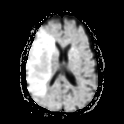 File:Carotid arterial dissection with acute cerebral infarction (Radiopaedia 26636-26784 Axial Exp ADC 13).jpg