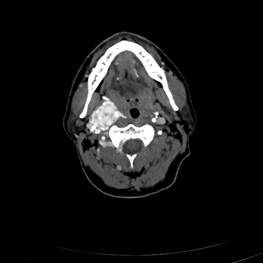 File:Carotid body tumor (Radiopaedia 83615-98727 A 46).jpg