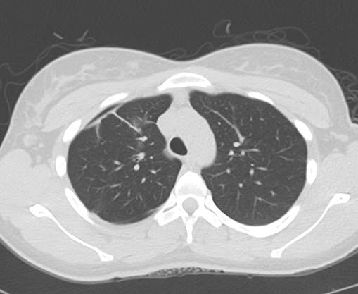 File:Catamenial pneumothorax (Radiopaedia 54382-60600 Axial 31).png