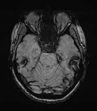 File:Cavernoma with bleed - midbrain (Radiopaedia 54546-60773 Axial SWI 17).png