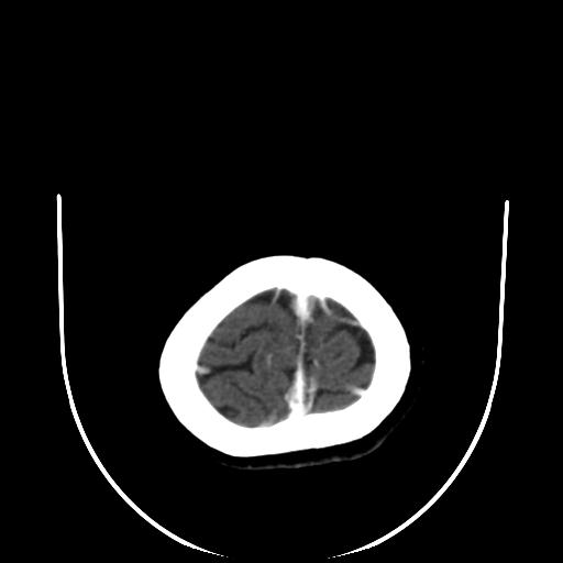 File:Cavernoma with developmental venous anomaly (Radiopaedia 22470-22506 C+ arterial phase 32).jpg