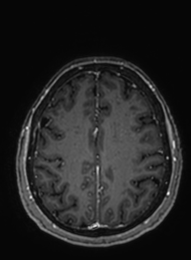 Cavernous hemangioma of the cerebellar falx (Radiopaedia 73025-83724 Axial T1 C+ 100).jpg