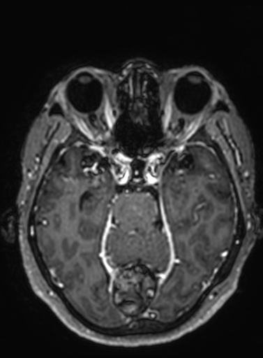Cavernous hemangioma of the cerebellar falx (Radiopaedia 73025-83724 Axial T1 C+ 217).jpg