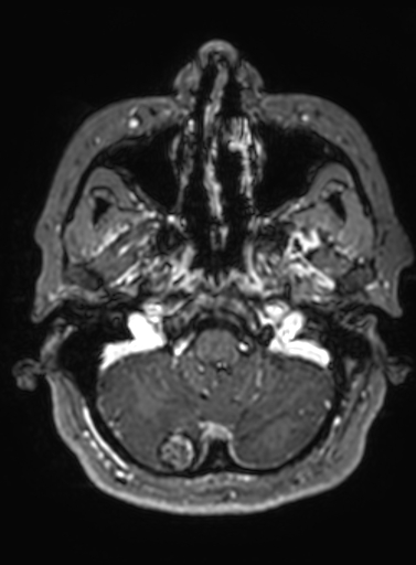 Cavernous hemangioma of the cerebellar falx (Radiopaedia 73025-83724 Axial T1 C+ 286).jpg