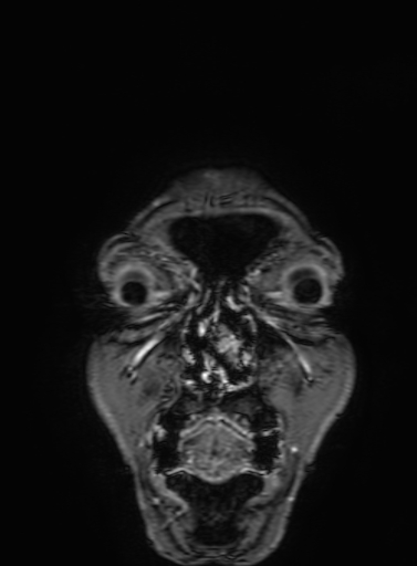 Cavernous hemangioma of the cerebellar falx (Radiopaedia 73025-83724 Coronal T1 C+ 13).jpg