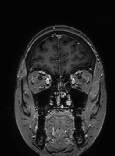 Cavernous hemangioma of the cerebellar falx (Radiopaedia 73025-83724 Coronal T1 C+ 70).jpg