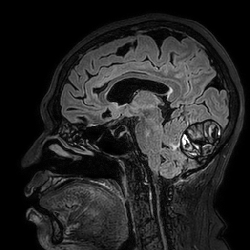 File:Cavernous hemangioma of the cerebellar falx (Radiopaedia 73025-83724 Sagittal FLAIR 117).jpg
