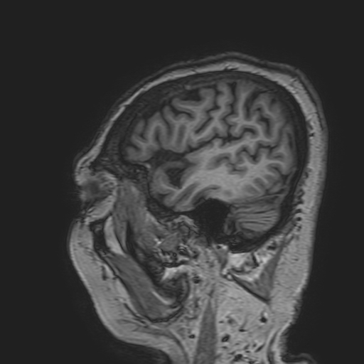 File:Cavernous hemangioma of the cerebellar falx (Radiopaedia 73025-83724 Sagittal T1 37).jpg
