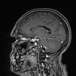 Cavernous sinus meningioma (Radiopaedia 63682-72367 Sagittal T1 C+ 105).jpg