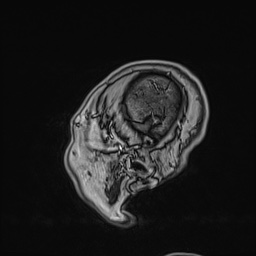 Cavernous sinus meningioma (Radiopaedia 63682-72367 Sagittal T1 C+ 156).jpg
