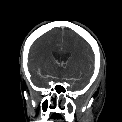 File:Cavernous sinus thrombosis (Radiopaedia 10619-11078 D 11).jpg