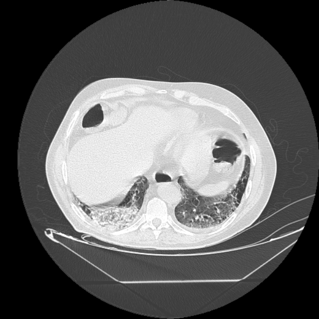 Cavitating bronchogenic carcinoma (Radiopaedia 44489-48162 Axial lung window 68).jpg