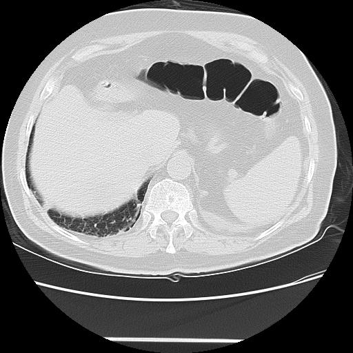 Cavitating pulmonary metastases (Radiopaedia 89545-106544 Axial lung window 52).jpg