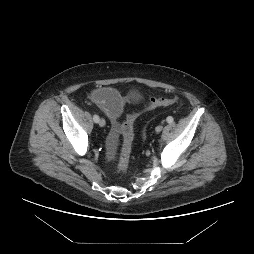 Cecal adenocarcinoma (Radiopaedia 64871-73817 A 80).jpg