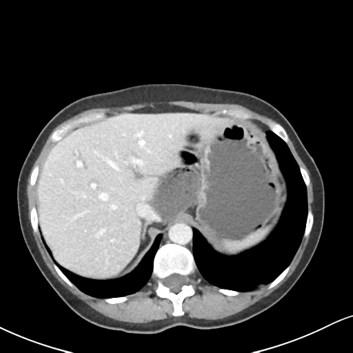 Cecal internal hernia through the foramen of Winslow (Radiopaedia 44820-48651 B 14).png