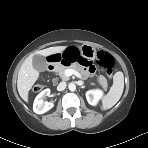 Cecal internal hernia through the foramen of Winslow (Radiopaedia 44820-48651 B 28).png