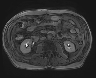 Cecal mass causing appendicitis (Radiopaedia 59207-66532 K 66).jpg