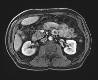 Cecal mass causing appendicitis (Radiopaedia 59207-66532 T1 C+ PV phase 60).jpg