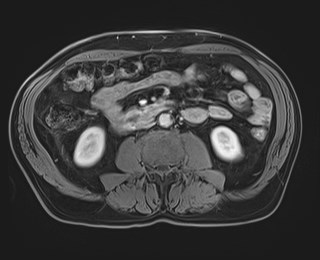 Cecal mass causing appendicitis (Radiopaedia 59207-66532 T1 C+ PV phase 73).jpg