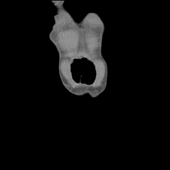 Cecal volvulus (Radiopaedia 69527-79408 B 6).jpg