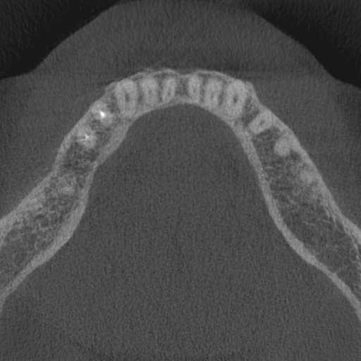 Cemento-osseous dysplasia (Radiopaedia 48251-53126 Axial non-contrast 33).jpg