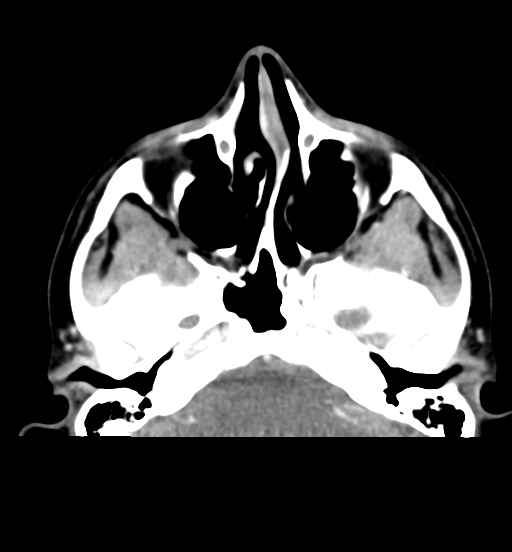 File:Cemento-ossifying fibroma (Radiopaedia 46243-50643 Axial C+ delayed 21).png