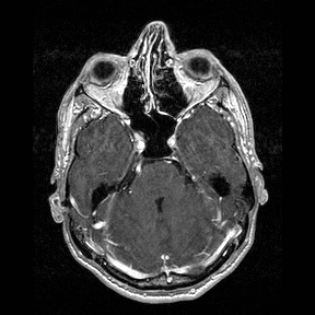 Central-variant posterior reversible encephalopathy syndrome (PRES) (Radiopaedia 43880-47358 Axial T1 C+ 41).jpg