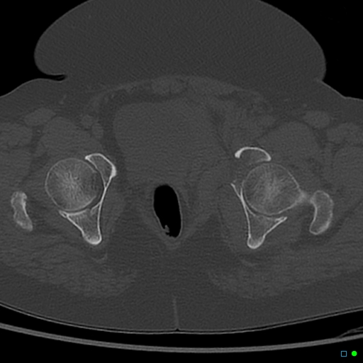 Central fracture-dislocation of the acetabulum (Radiopaedia 36578-38150 Axial bone window 64).jpg