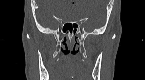 File:Central giant cell granuloma (Radiopaedia 83346-97761 Coronal bone window 21).jpg