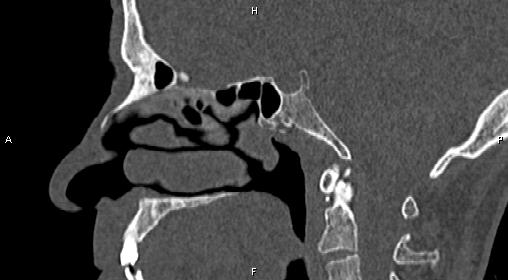 File:Central giant cell granuloma (Radiopaedia 83346-97761 Sagittal bone window 26).jpg