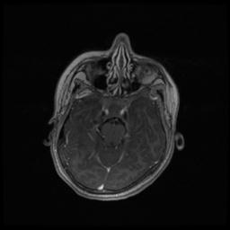 Central neurocytoma (Radiopaedia 30220-30842 Axial T1 C+ 48).jpg