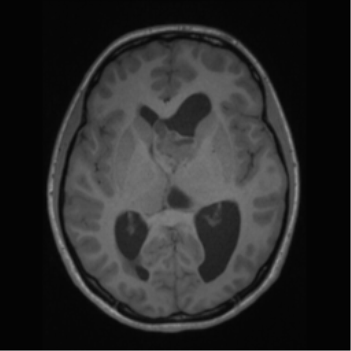 File:Central neurocytoma (Radiopaedia 37664-39557 Axial T1 37).png